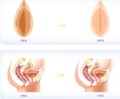 私密整形前后對比圖