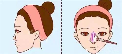 隆鼻位置图_看图王