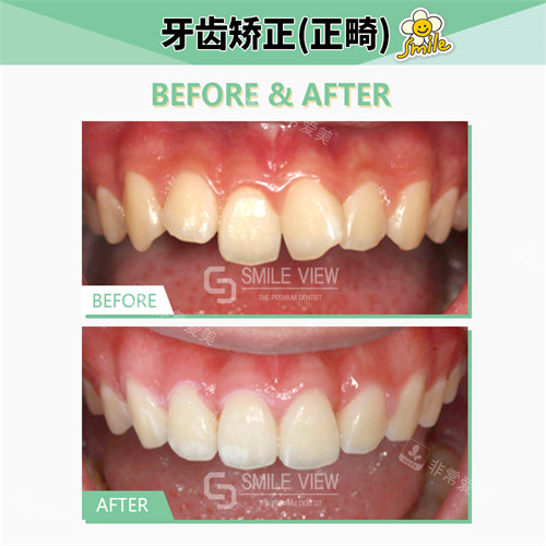 在韩国SMILEVIEW牙科正畸前后对比图