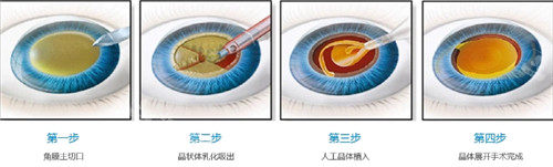 白内障手术过程图