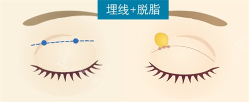 埋線雙眼皮動畫圖
