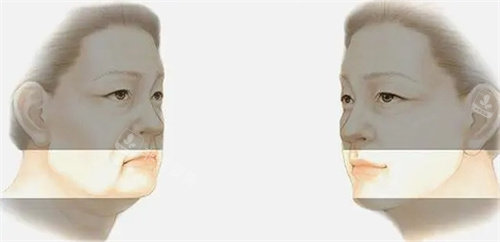 面部提升动画图