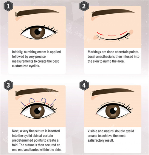 埋线双眼皮手术流程图