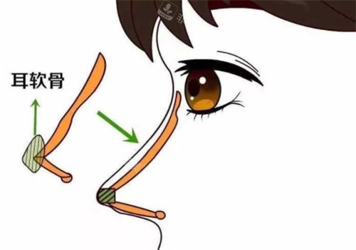 耳軟骨隆鼻動畫圖 耳軟骨隆鼻動畫圖