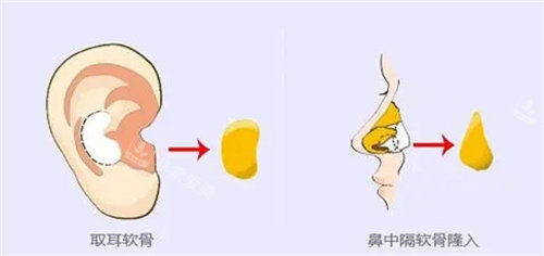 耳软骨隆鼻流程图