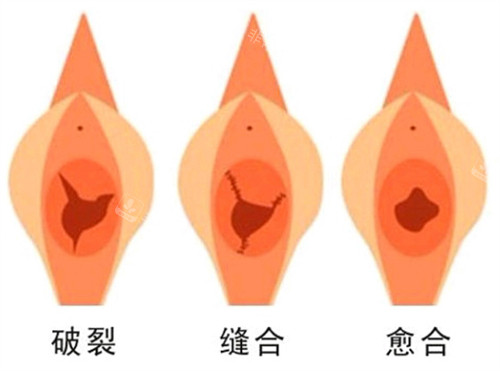 處女膜修復(fù)手術(shù)前后對(duì)比圖