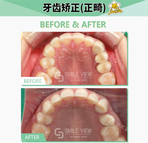 韓國江南SMILE VIEW牙科正畸對比圖