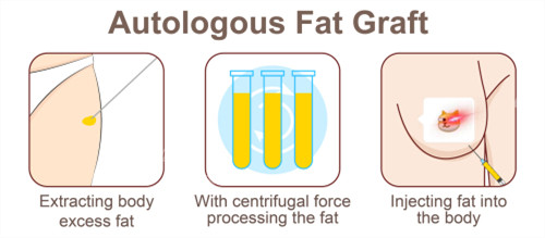 自体脂肪隆胸过程