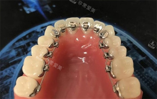牙齿矫正模型图