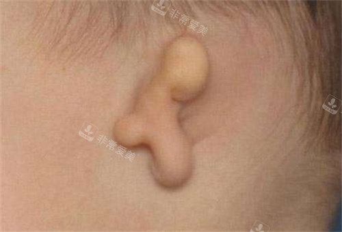 小耳畸形展示图