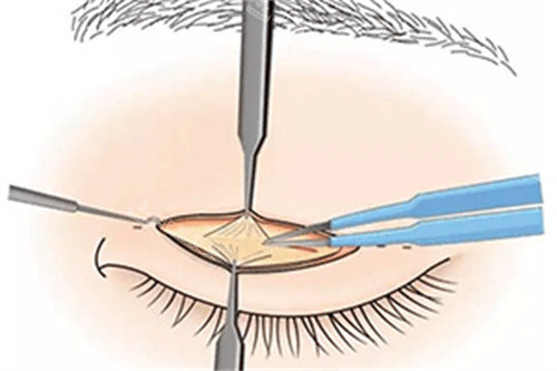 雙眼皮修復(fù)手術(shù)過程圖解
