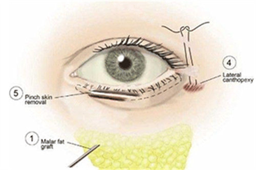 祛眼袋手术过程