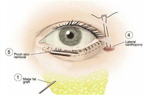 祛眼袋手術(shù)過程