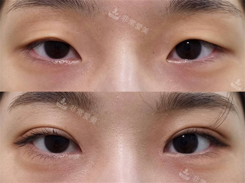 韩国merry整形外科双眼皮手术前后对比图