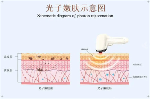 光子嫩肤前后肤质对比图