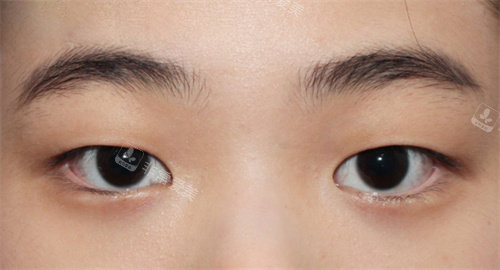韩国赫尔希整形外科双眼皮手术前照片