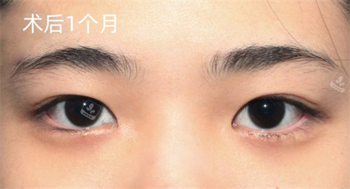 韩国赫尔希整形外科双眼皮手术术后照片