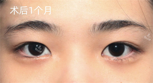 韓國(guó)赫爾希整形外科雙眼皮手術(shù)術(shù)后照片 韓國(guó)赫爾希整形外科雙眼皮手術(shù)術(shù)后照片