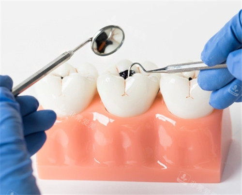 牙齿治疗模拟动画图