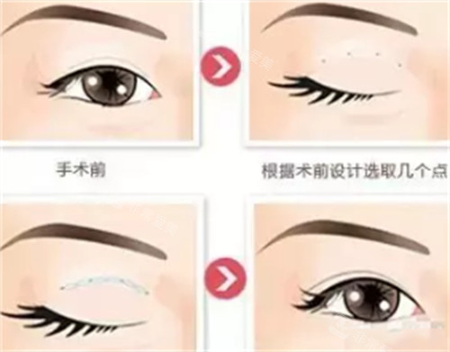 三点式双眼皮手术过程图解