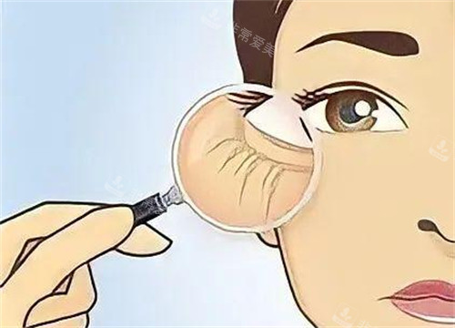 眼角生出细纹的样子图片 眼角生出细纹的样子图片