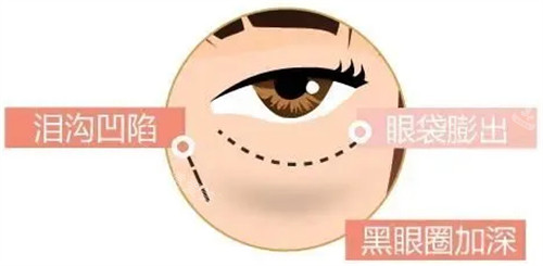 眼部衰老出现的问题图解 眼部衰老出现的问题图解