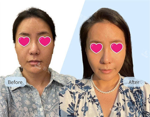 韓國波輪美面部抗衰提升術(shù)前術(shù)后對比圖 韓國波輪美面部抗衰提升術(shù)前術(shù)后對比圖