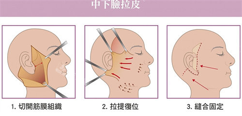 拉皮手术动画图