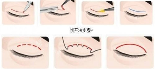 双眼皮流程图