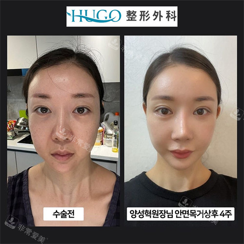 韩国HUGO整形外科面部颈部提升前后对比正面