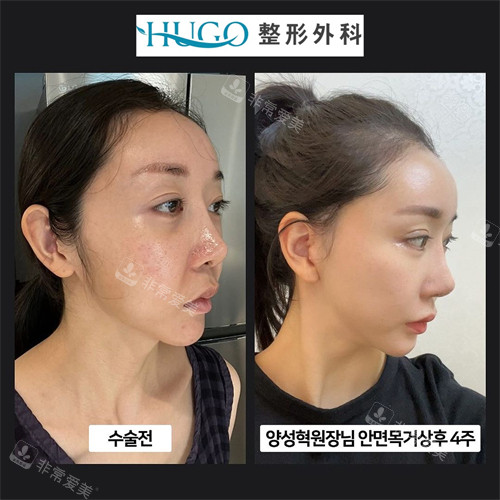 韩国HUGO整形外科面部颈部提升前后对比侧面