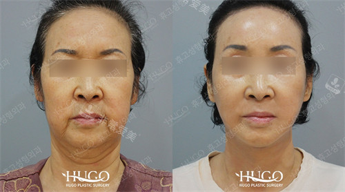 韩国HUGO整形外科面部颈部提升有多赞!!!HUGO整形外科真人手术前后分享