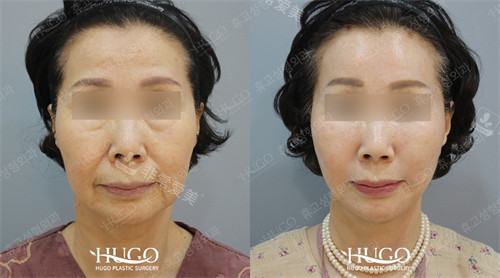 韩国HUGO整形外科面部颈部提升对比三
