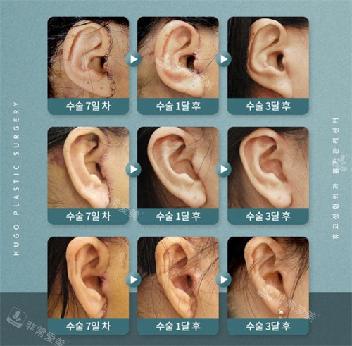 韓國(guó)HUGO整形外科面部提升手術(shù)切口恢復(fù)情況