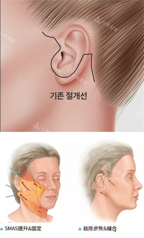 韩国HUGO整形外科面部提升手术切口方向