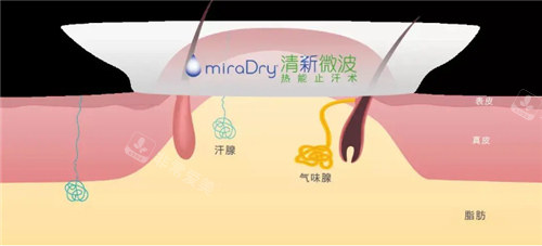 miradry微波去腋臭原理图