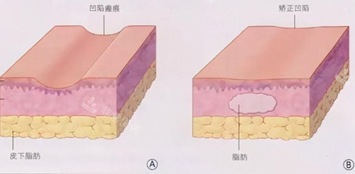 李朕医生脂肪整形价格