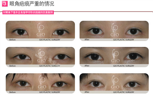GIO整形外科眼角疤痕修复对比照