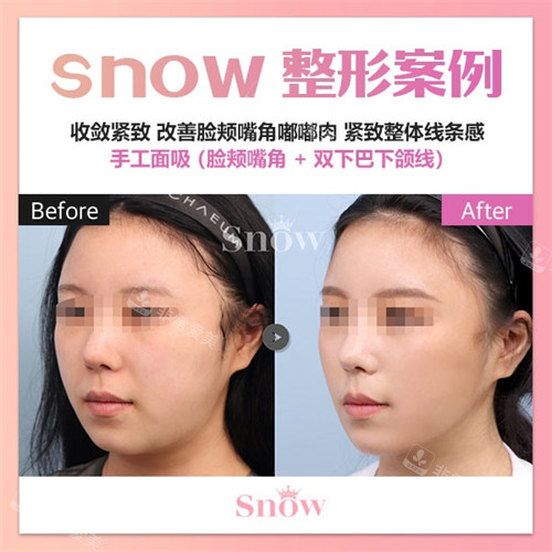 韩国snow整形外科面吸前后对比