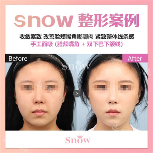 韩国snow整形外科面部吸脂对比照