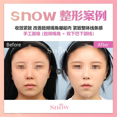 韓國snow整形外科面部吸脂對比照