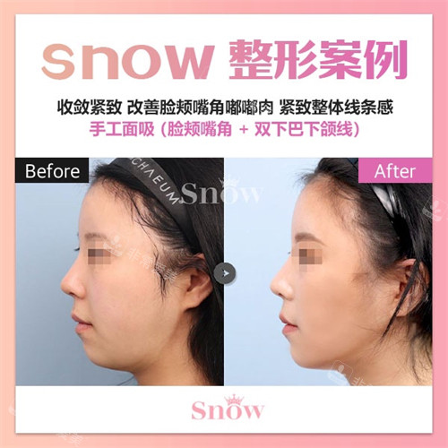 韩国snow整形面部吸脂手术后侧面的前后对比图