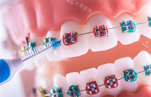 矫正牙齿使用的金属牙套