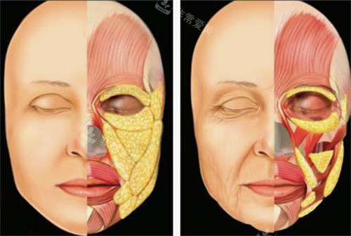 衰老后皮下组织的变化图解