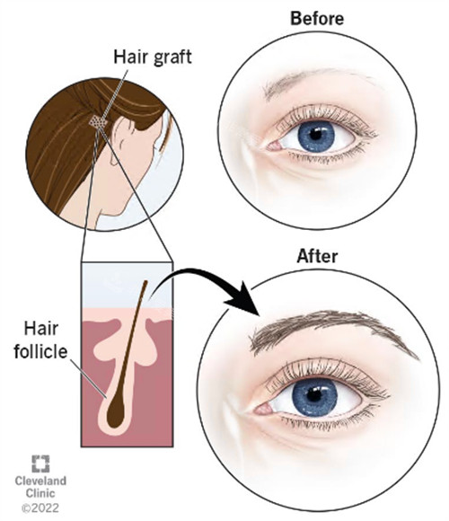 眉毛种植图示