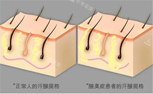 汗腺对比图