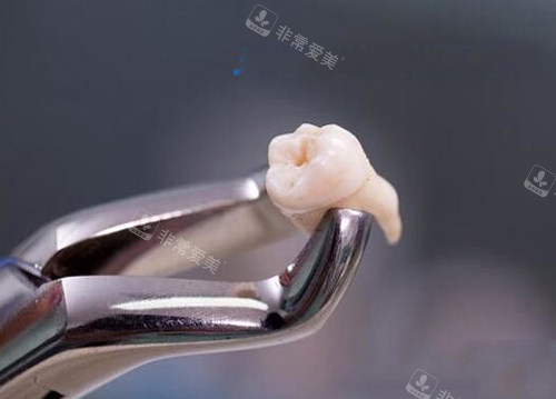 拔牙图示