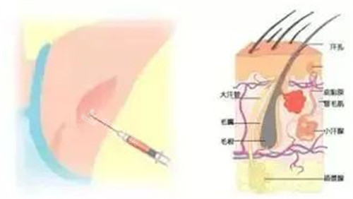 注射去腋臭的过程图解