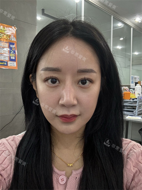 韓國DL整形外科鼻修復(fù)術(shù)前正面圖