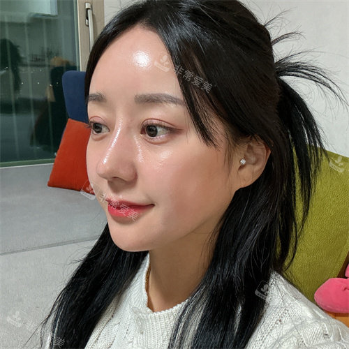韩国DL整形外科鼻修复术后侧面图